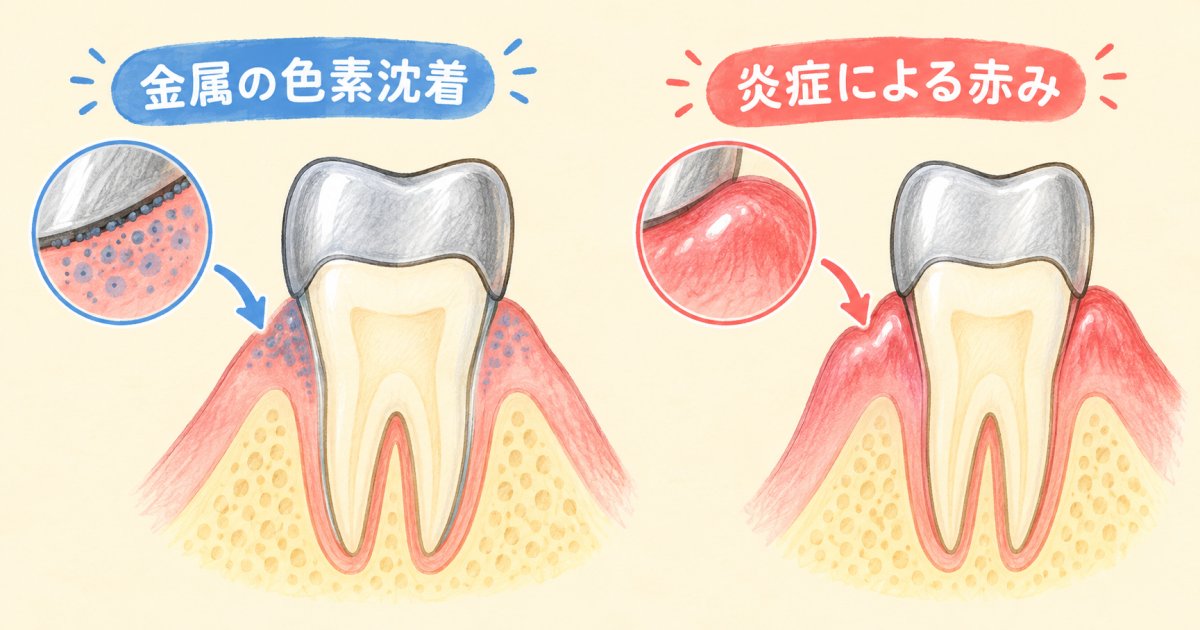 前歯の銀歯まわりの歯茎が黒ずむ仕組み