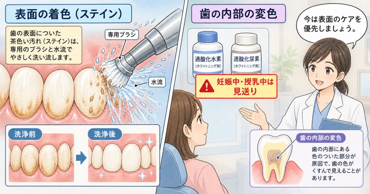 妊娠中・授乳中に歯を白くする前に、漂白と着色除去を分けて考える