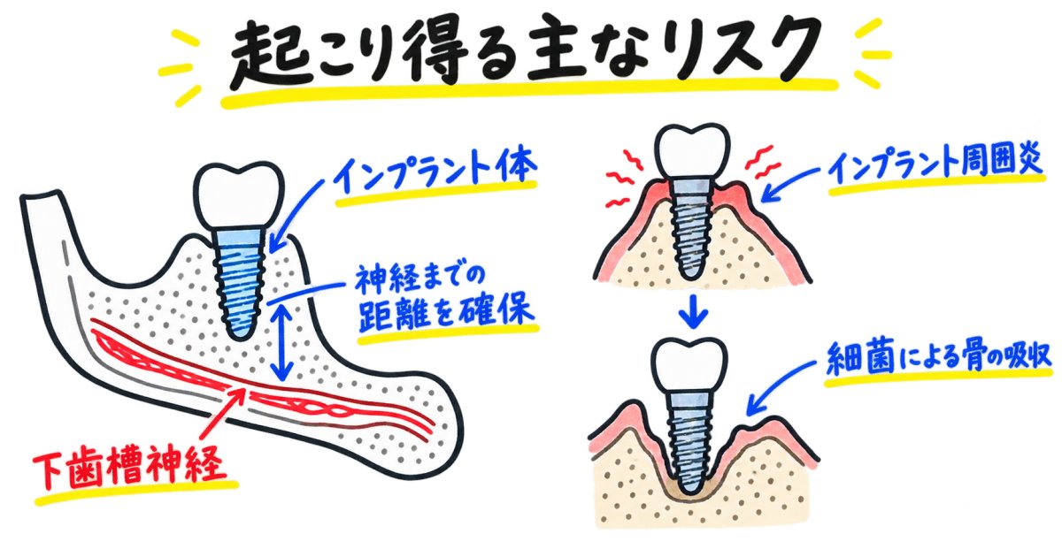 インプラント手術で起こり得る主なリスクと発生要因