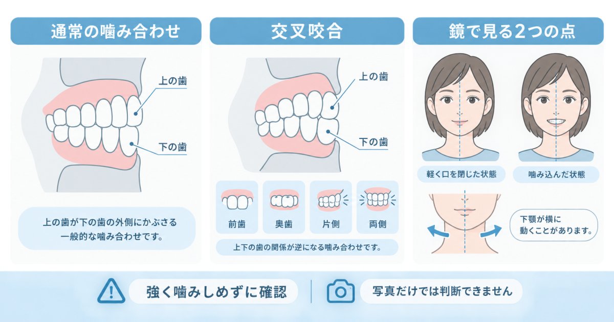 交叉咬合はどう見分ける？写真と噛み合わせで見る点